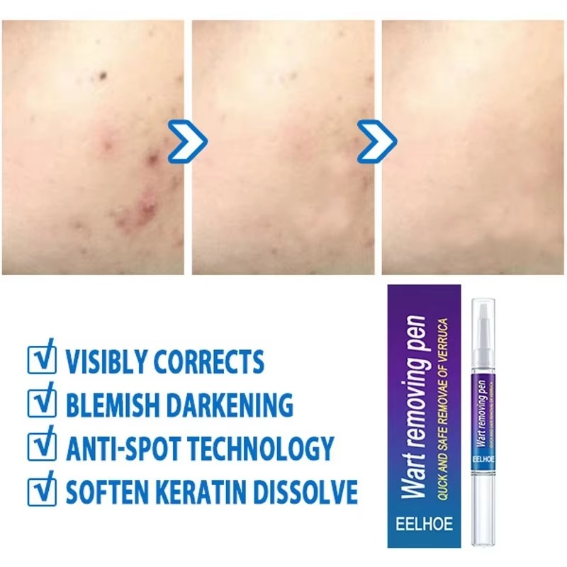 Wart Removal Mole Remedy Liquid Pen