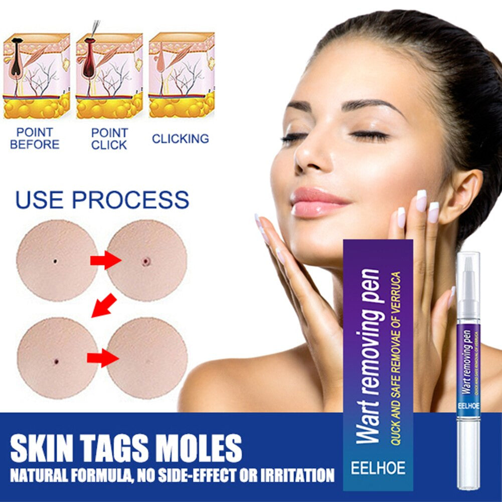 Wart Removal Mole Remedy Liquid Pen