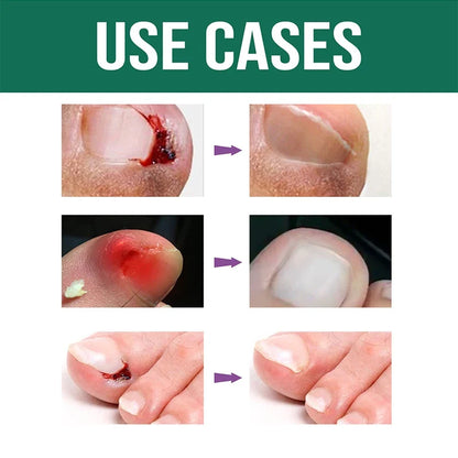 Anti Paronychia Relief Oil