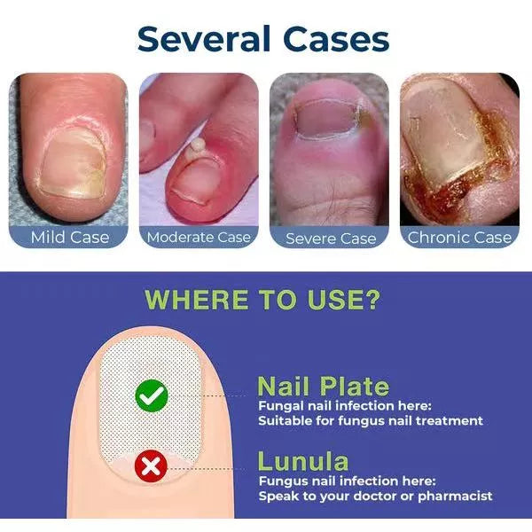 Anti Paronychia Relief Oil