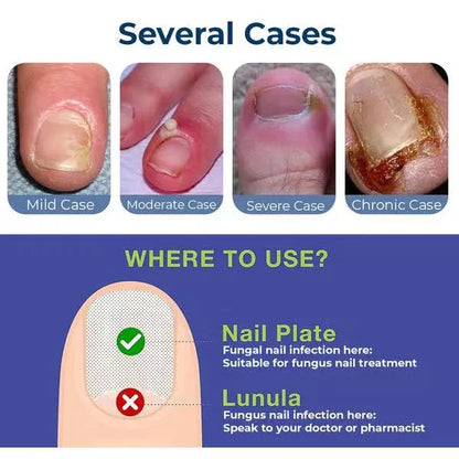 Anti Paronychia Relief Oil