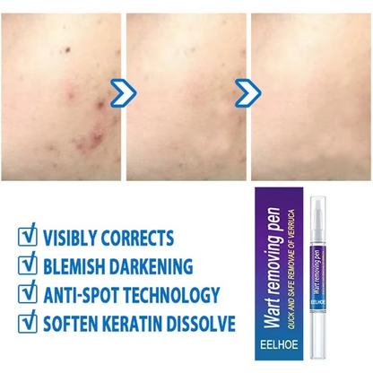 Wart Removal Mole Remedy Liquid Pen